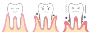 denti che si muovono